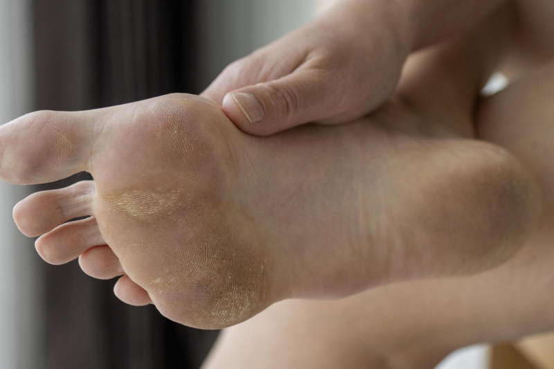 Podologia tratamento de micose e suas melhores práticas