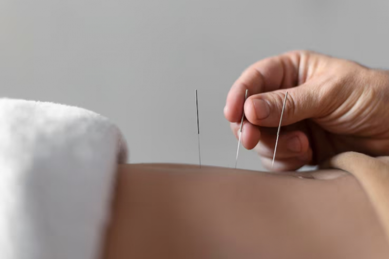 Como a Acupuntura Ajuda no Tratamento da Ansiedade